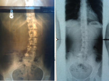 Lumbar straightening using Elevator