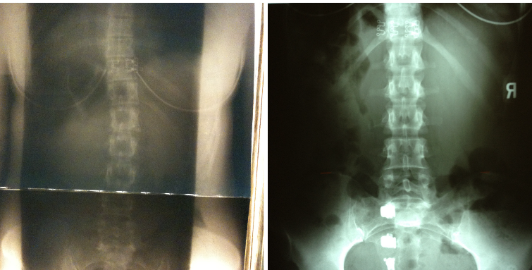 Thoracic Straightening using Elevator